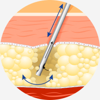 흡입관으로 지방흡입