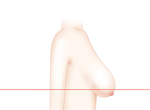 출산/수유에 지장 없는 수술