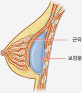 코헤시브 실리콘겔 보형물