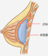 코헤시브 실리콘겔 보형물