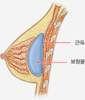 코헤시브 실리콘겔 보형물